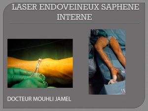 Endovenous laser treatment.